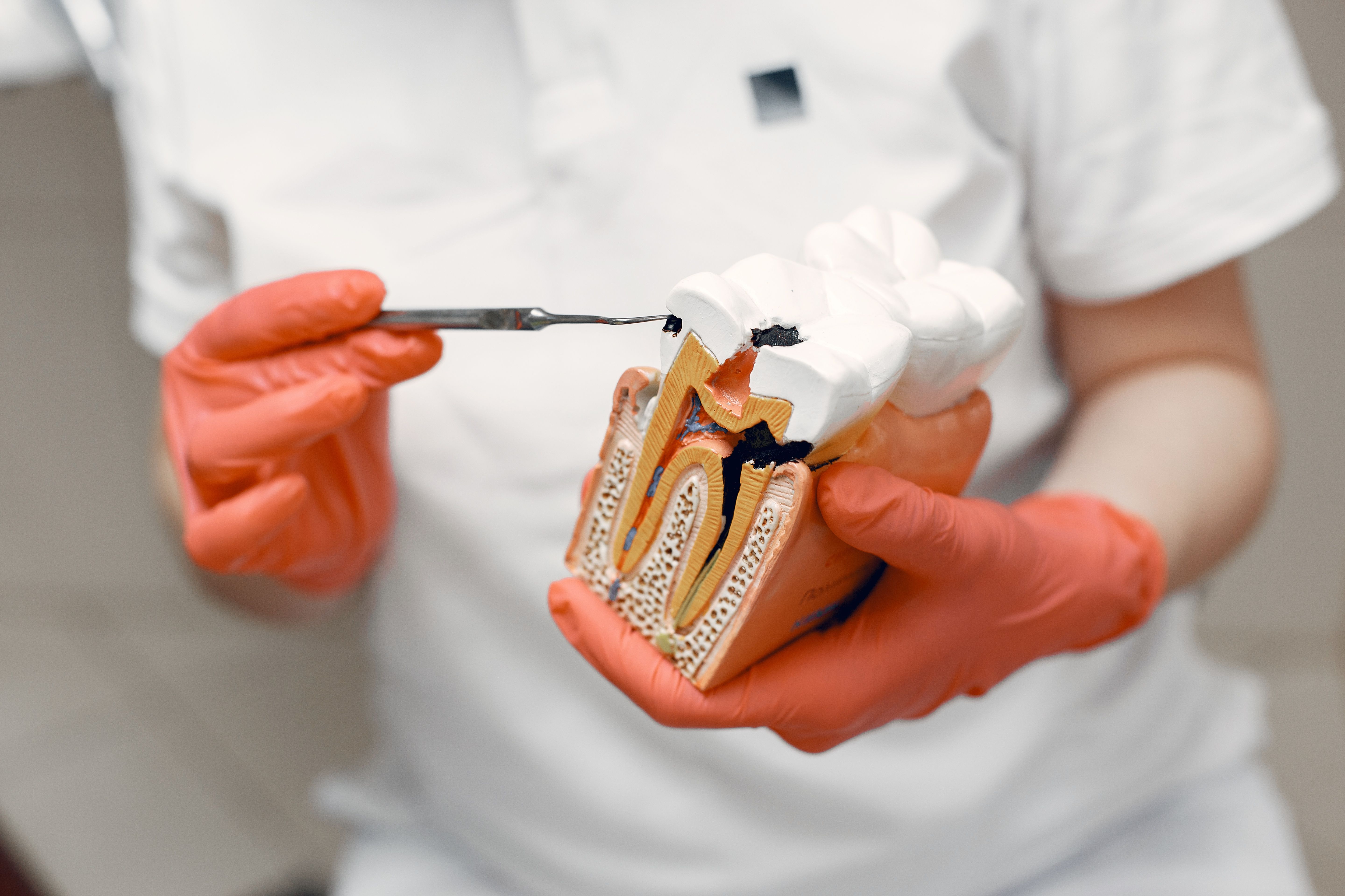 Tooth Extractions