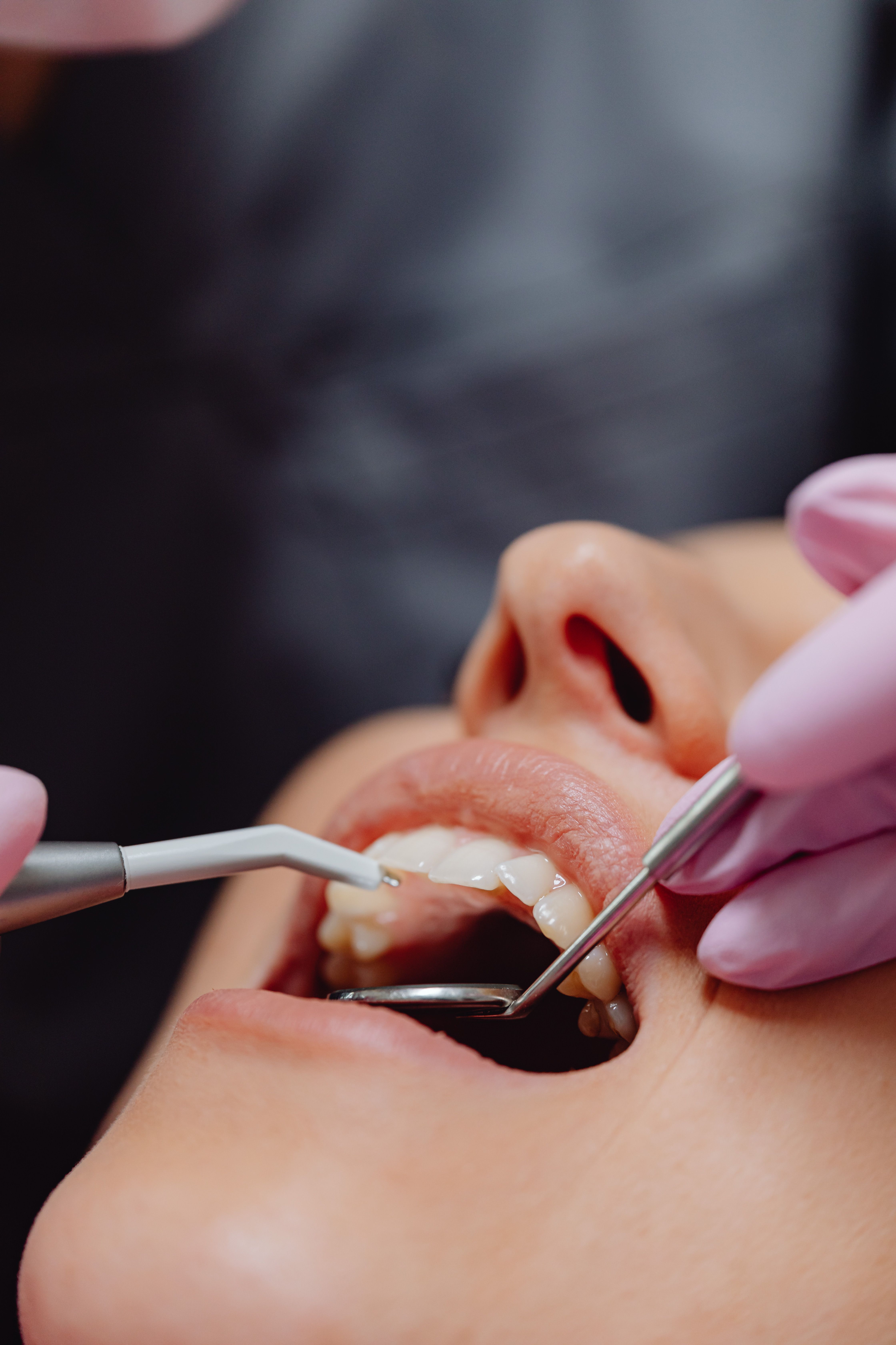 Tooth-Colored Fillings